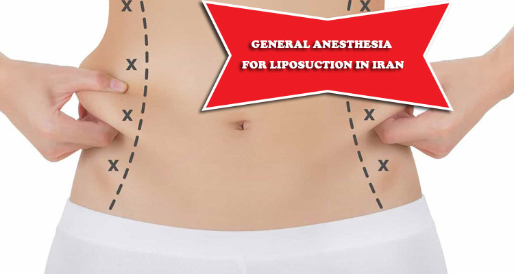 General anesthesia for liposuction in Iran
