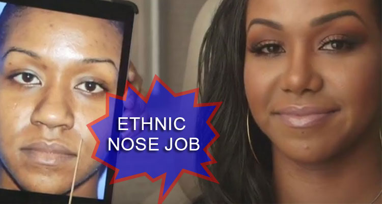 Ethnic nose job