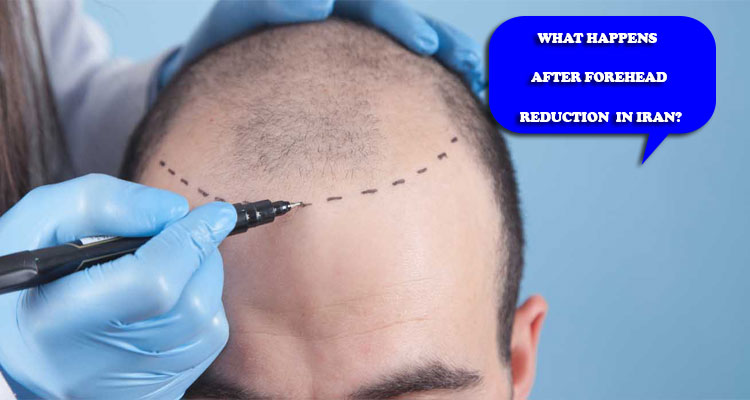 What happens after forehead reduction in Iran?