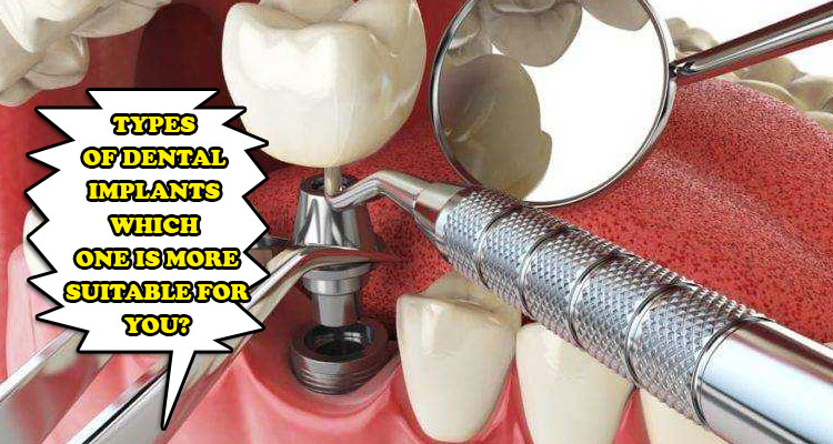 Types of Dental Implants - Which One is More Suitable for You?