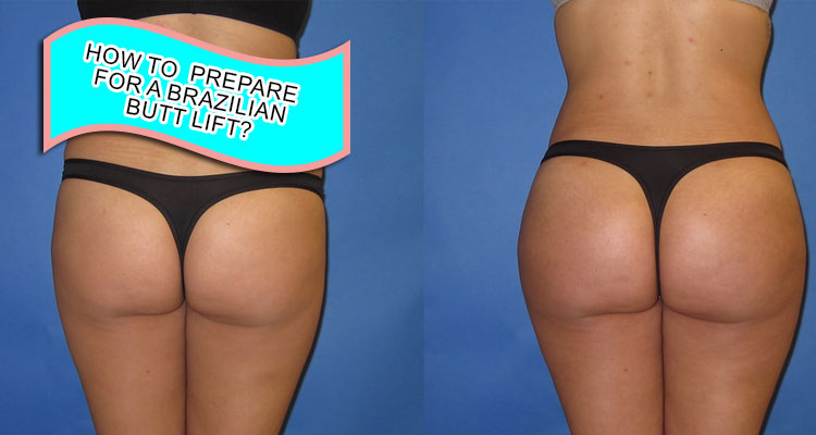 How to prepare for a Brazilian butt lift?