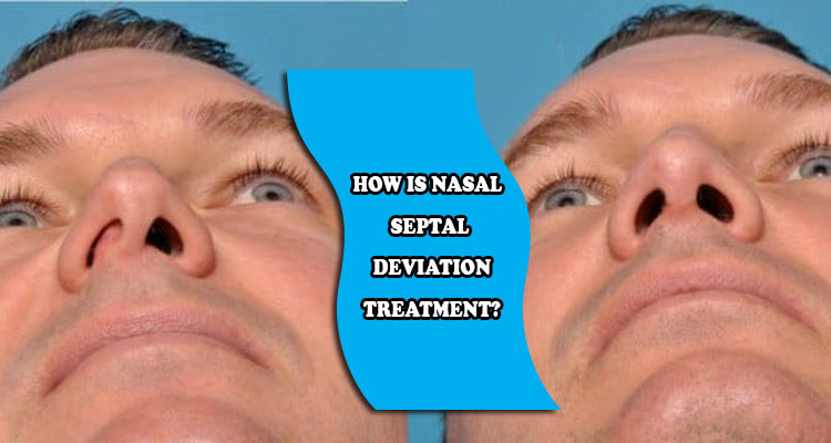 How is nasal septal deviation treatment?