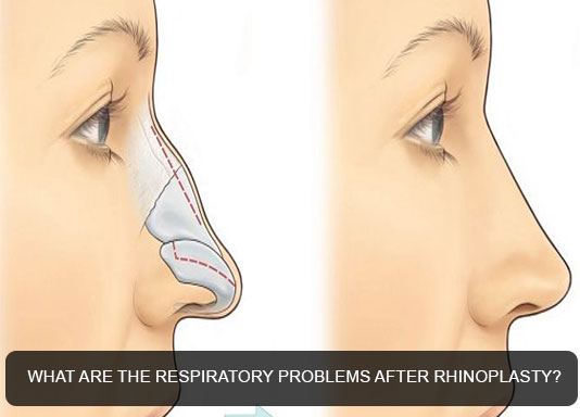 What are the respiratory problems after rhinoplasty?