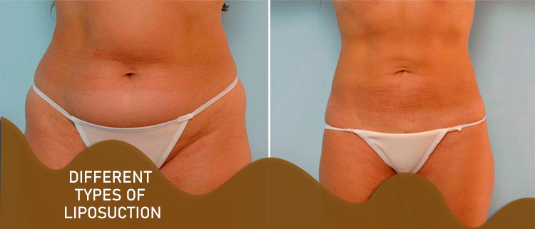 different types of liposuction