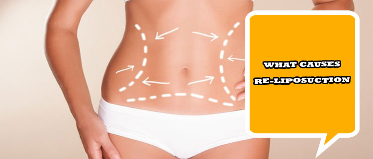 What causes re-liposuction in Iran?
