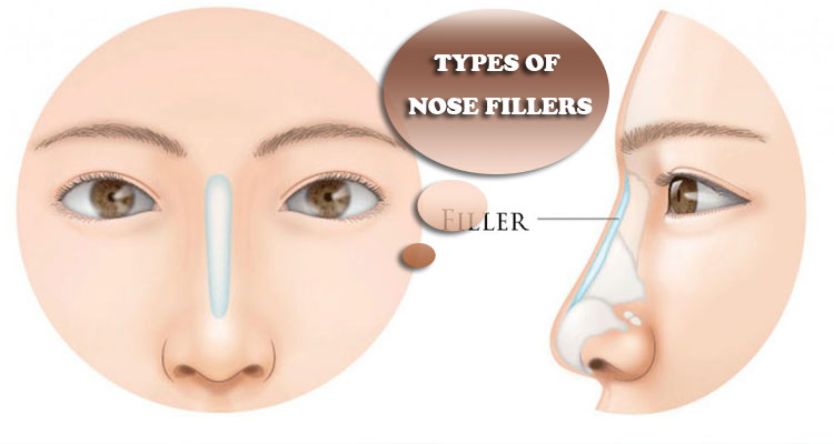 Types of nose fillers