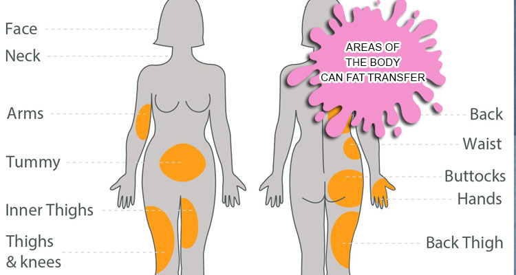 areas of the body can fat transfer
