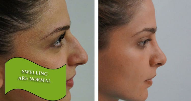 swelling are normal