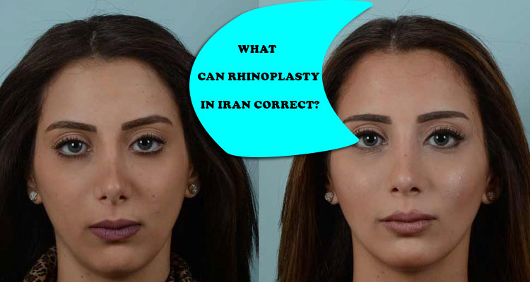 What can rhinoplasty in Iran correct?