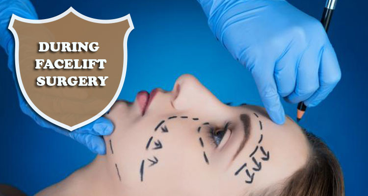 during facelift surgery