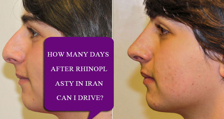 How many days after rhinoplasty in Iran can I drive?