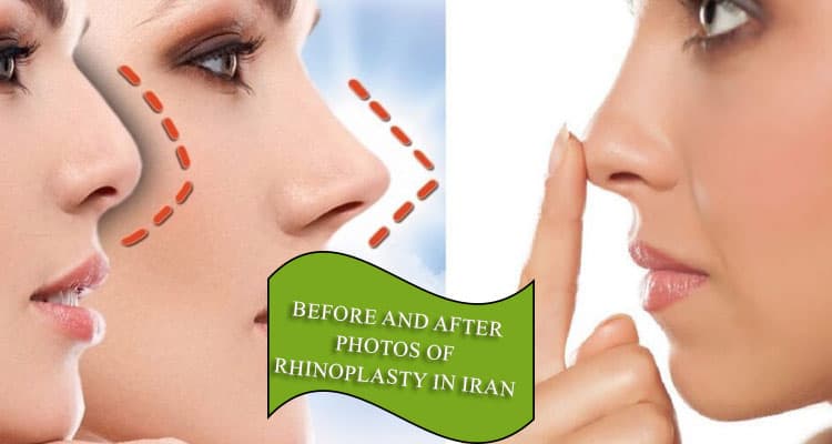 Before and after photos of rhinoplasty in Iran
