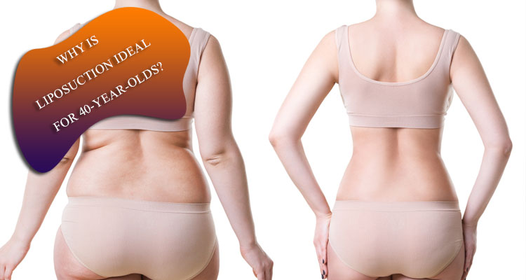 Why is liposuction ideal for 40-year-olds?