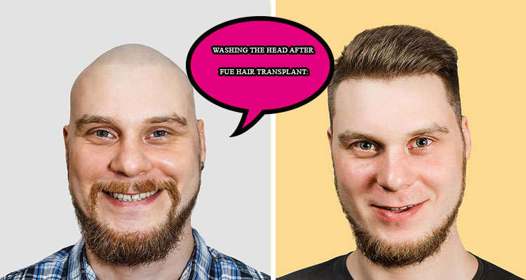 Washing the head after FUE hair transplant: