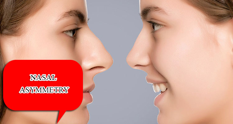 Nasal Asymmetry