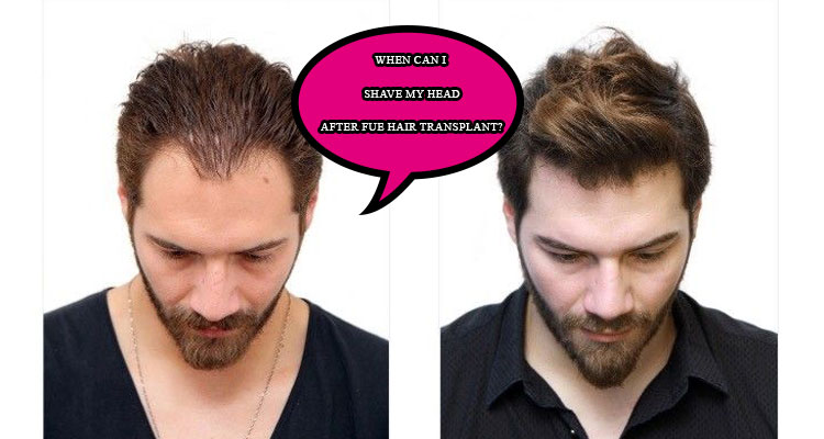 When can I shave my head after FUE hair transplant?