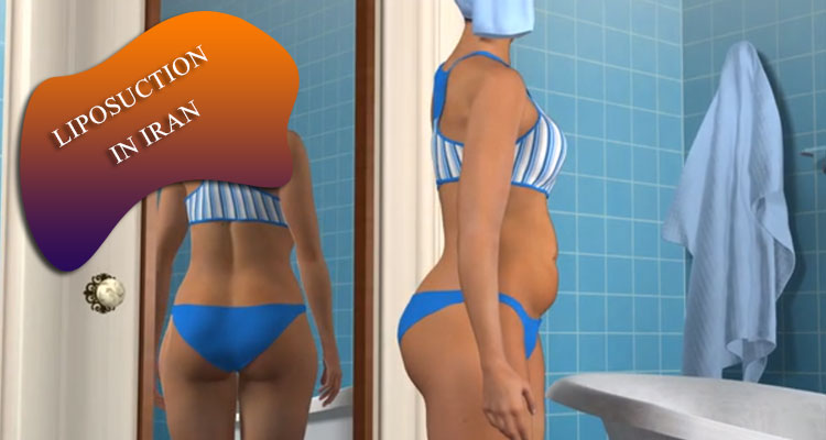 liposuction in Iran