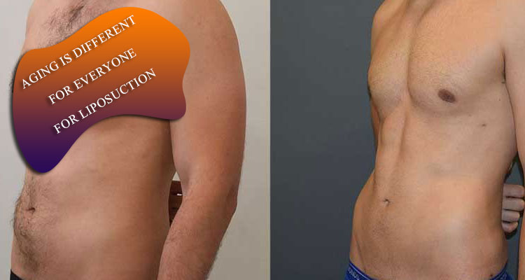 Aging is different for everyone for liposuction in Iran