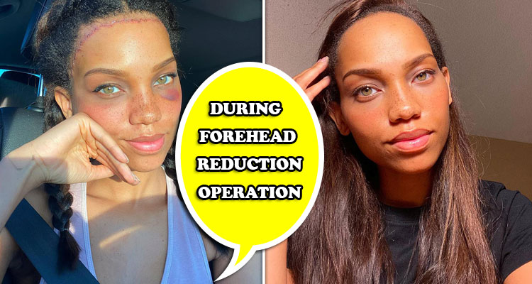 During forehead reduction Operation