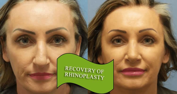 recovery of rhinoplasty