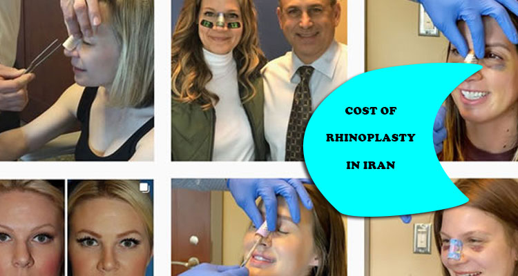 Cost of rhinoplasty in Iran