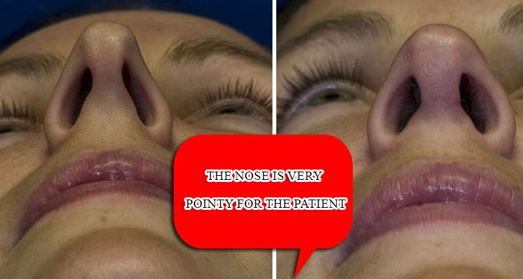 The nose is very pointy for the patient