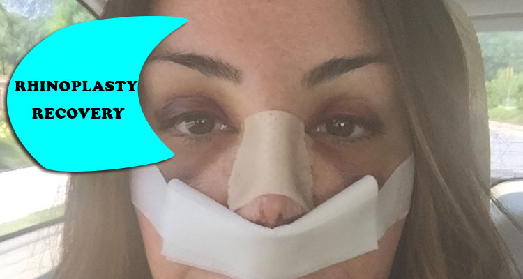 Rhinoplasty Recovery