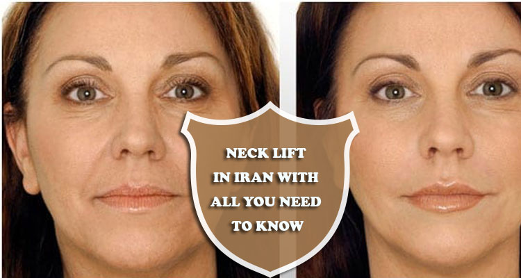 Neck lift in Iran with all you need to know