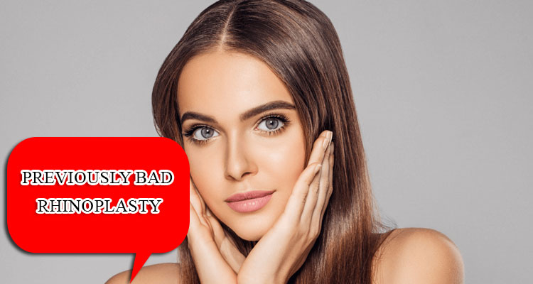 Previously bad rhinoplasty