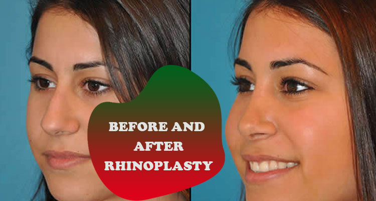 before and after rhinoplasty