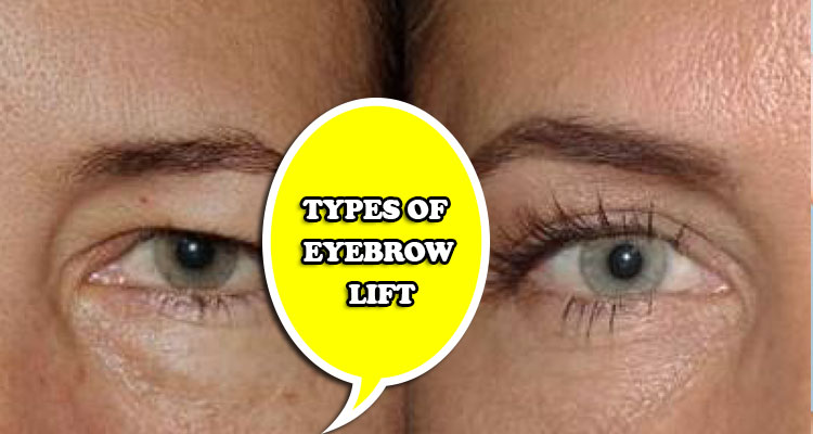 types of eyebrow lift