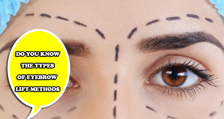 Do you know the types of eyebrow lift methods