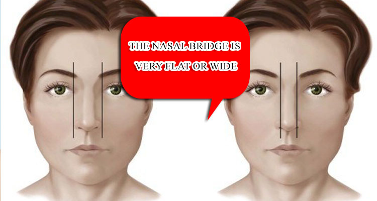 The nasal bridge is very flat or wide
