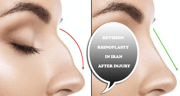 Revision rhinoplasty in Iran after injury