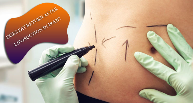 Does fat return after liposuction in Iran?