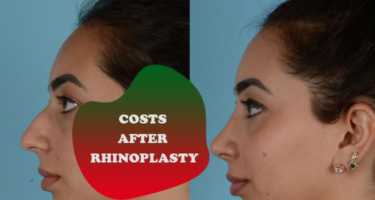 after rhinoplasty