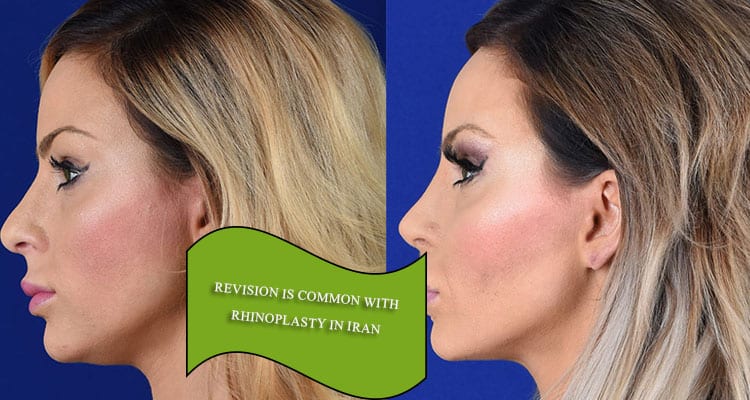 rhinoplasty in Iran is one of the most common plastic surgeries in the world. There are some factors which must be taken into account before rhinoplasty in Iran. 1.Talk to the surgeon about rhinoplasty in Iran An initial consultation with a physician is an integral part of any plastic surgery in Iran. To ensure that your procedure goes well, you should make the most of this opportunity. In addition to being straightforward about your medical history, the medications you are taking, and the counter-indications you are aware of, ask your doctor the following questions about rhinoplasty in Iran: 1.How many years of experience do you have in nose job surgery? 2.How many nose job surgeries have you performed? 3.Am I a good candidate for rhinoplasty in Iran? 4.Where will you do this surgery? 5.How will the nose surgery be performed? 6.What surgical procedure do you recommend for my case? 7.How long does recovery take? 8.What happens if complications occur? 9.What options do I have if I am not satisfied with the results of this plastic surgery in Iran? 10.Can I look at before and after photos of your patients? 11.Can I watch a video of a rhinoplasty you have performed? 12.What type of anesthesia will I be under? Feel free to ask all of the questions you have regarding the surgery. Nose job surgery can be a life-changing procedure (in a good way) so there is no problem in being fully prepared. 2. Get ready for recovery of rhinoplasty in Iran It takes about 7 to 14 days for you to resume your normal activities after rhinoplasty in Iran. You will experience swelling and bruising immediately after this plastic surgery in Iran. You may prefer to stay home for a few days after the operation, or at least until the cast is removed. To ensure a speedy recovery, consider making a few preparations: 1.Save medical supplies Ask your surgeon about any medications you may need after surgery and buy them in advance. Fill all required prescriptions. 2.Buy food and drink before rhinoplasty in Iran Make sure you have enough water and healthy snacks to ensure proper nutrition and hydration after this plastic surgery in Iran and "rhinoplasty in Iran". 3.Arrange child and pet care  Ask someone to help you with children and pets at least 24 hours after the operation. 4.Prepare practical clothing  think about buying loose or button-up shirts. Wearing clothes over your head can be uncomfortable.Ask a friend or family member to stay with you for 24 hours after the operation, or at least be on call if something is needed.Important: You will need someone to take you home after this plastic surgery in Iran. 3. Adjust your diet Every surgery is a stress for your body. Adjust your diet to help it through the procedure and recovery. Try to eliminate processed foods and increase your intake of fibrous foods. This can help prevent constipation, which may be associated with anesthesia and post-surgery medications. Maintain a healthy diet throughout the healing process to help your body heal faster. However, try to avoid any drastic changes in your diet and lifestyle before rhinoplasty in Iran. 4. Arrange leave of absence The overall recovery period of rhinoplasty in Iran varies from patient to patient. Take at least 7 to 10 days off work to give yourself a chance to recover. If you work remotely, you still need a few days to get back in shape. If your job requires lifting heavy objects or other strenuous activity, talk to your doctor about the recommended duration of your leave. 5. Do blood tests Before surgery, your doctor should do several tests to make sure you are ready for this plastic surgery in Iran. A blood test will show: 1.Hemoglobin levels 2.Ability to clot blood 3.HCG levels (to indicate pregnancy for women) 4.And everything else your doctor should check. You can have a blood test at a plastic surgery clinic in Iran or use a lab of your choice. 6.Before and after photos of rhinoplasty in Iran Once you have narrowed down your choices to a few surgeons, start looking through their photo gallery. Look carefully at the pre- and post-rhinoplasty in Iran photos, considering patients with similar facial features to you. Then ask yourself if you like their outcomes. Do you want something different? Write down some notes and bookmark cases you like best These pre-and-post surgery images can give you a much more realistic picture of what is possible for your results than 3-D imaging and discussion with the doctor alone. Plus, they can contribute you get an idea of the surgeon’s work. When you meet an experienced surgeon in person, he or she should be able to provide you with several samples of noses with similar characteristics to you and a range of results depending on your individual wishes You may also be looking for some more examples outside of your doctor's website. Find some examples of the noses you like to see on yourself available in before and after galleries, celebrity faces and other sources. Take those "desirable photos" with you to your consultation session. 3D imaging for rhinoplasty in Iran Many surgeons emphasize 3D imaging of rhinoplasty in Iran to help the patient visualize their outcome. However, there are significant drawbacks that patients need to recognize. There are many patients for revision rhinoplasty in Iran who bring in the image their original surgeon provided but was not able to reproduce. There is a concept that can lead to false expectations and is not necessarily a reflection of the surgeon's skill. The dominant belief is that imaging systems have the inherent assumption that the nose is a piece of clay that can be molded in any way. However, the nose is made up of 5 main cartilages and a bony part that is covered by a skin covering of variable thickness. The skin can at best be minimally changed by thinning slightly, and the framework must have enough strength, which places constraints on what can be done. The dominant philosophy is to change the cartilage and bony framework to only correct what is displeasing while sustaining structural strength, which leads to a natural result that cannot be fully foreseen by an imaging system. While imaging can be useful, there are examples of pre- and post-op photos of patients with similar noses to give you a more realistic vision of what is reliably achievable. 7.Realistic expectations of results rhinoplasty in Iran While it is a great idea to bring pictures of rhinoplasty in Iran favorite noses as inspiration to your counseling session, keep in mind that no surgery can make you look like anyone else. In fact, customizing each patient's results to achieve their aesthetic goals, the following factors must be taken into account: 1.Underlying framework of the nose 2.Skin thickness 3.Other facial features Because of these factors, no two patient outcomes will be the same - and that's a good thing. You need to have a natural result that fits your unique face. 8.Bruising and swelling are normal in the first week Nose surgery in Iran (rhinoplasty in Iran) has bruising and swelling similar to a broken nose. The area around your eyes turns black after three to five days and the swelling will continue for up to a week. Schedule your surgery around any specific event because it takes at least a few weeks for the swelling and bruising to go away completely. 9.Your final result will be clear after roughly one year It will not take you that long to heal, but for all of the swelling to go away completely. Many patients are astonished that their noses continue to heal and may go through difficult stages of asymmetry until a year after rhinoplasty in Iran. 10.Do not exercise for a month An increase in heart rate leads to swelling, and this is exactly what you want to avoid after any surgery. A heart rate of more than 100, which is common in any type of aerobic exercise, is sure to cause swelling of the nose, even bruising and bleeding. 11.Prepare yourself for the symptoms of rhinoplasty You may be surprised to learn that most rhinoplasty in Iran patients are significantly more comfortable after surgery. In fact, severe pain is very rare. The main symptoms that make patients more uncomfortable are stuffiness, swelling and bruising that are present in any rhinoplasty procedure. Fortunately, these can be easily controlled with the help of over-the-counter painkillers such as ibuprofen or acetaminophen. 12.Know what is normal Before fearing that the results of your rhinoplasty in Iran may not be what you expect, take the time to understand what is normal after surgery. Congestion, minor bleeding, swelling, and drowsiness are all normal. But if you experience other symptoms, it is recommended to call your doctor. 13.You will come for follow-up appointment about a week after the nose job In this session, your nasal splint will be removed and you will probably have a little pain during this operation. 14.How committed are you to rhinoplasty in Iran? Having nose job in Iran performed is a process, not an event, especially for patients whose surgical schedules include breaking the nasal bone. While you’ll initially have a 2-week recovery time period during which you won’t be able to go to work or school, it can take months to completely recover from nasal surgery depending on how invasive your surgical plan is. Are you well-prepared for the commitment to the process you are required to make? 15.Revision is common with rhinoplasty in Iran Of all plastic surgery in Iran, nose job and breast augmentation have the highest rate of revision. With breast augmentation, this is because breast implants can rupture or cause side effects. Women also may simply want to alter the appearance of their breasts as their bodies and preferences change over time. With nose surgery, the revision rate is high because of the complicated nature of the nose and its ability to improve, even when performed by the most qualified and experienced surgeon. As a precaution, patients should predict the need for a secondary rhinoplasty in Iran  procedure to fine-tune any potential imperfections. If you are thinking of nose job, these points should not prevent you from scheduling a consultation. Every patient is unique, and many of the factors of surgery are foreseeable and controllable. The best way to guarantee the best possible results is to select a surgeon with experience and expertise in nose surgery. 16.Am I really ready to look different of rhinoplasty in Iran? Many patients go for rhinoplasty in Iran regardless of the fact that they will look different afterwards and may take some time. Even if your nose is reshaped exactly the way you wanted it to be, you may not be ready for the shock of seeing it on your face for the first time. Of course, you will adapt to this significant change, but it may take some time. If you are worried about the shock of that massive change, talk to your plastic surgeon. He or she should be able to give you pictures or predictions of how your nose will look after surgery. Some surgeons may be able to show you pictures of previous patients with similar nasal structures to help you imagine your new appearance. To alleviate your anxiety, try visualization to prepare yourself emotionally for the new look you will see. Opportunities are very good that you’re going to like it. Things not to do before rhinoplasty in Iran Here are some things you should not do before rhinoplasty in Iran: 1.Drink alcohol at least a week before surgery Alcohol can change the effect of anesthetic medicine. It can also meddle with correct blood clotting. 2.Smoking - at least one week before rhinoplasty in Iran and during recovery Substances in cigarette smoke interfere with the respiratory function and metabolism of anesthetics. 3.Expose unprotected skin to ultraviolet light a few days before surgery and during recovery. Pre-surgery sunburn can increase the risk of inflammation and bleeding. It can also decrease the speed of the recovery process. 4.Complex skin care regimen  at least four days before rhinoplasty in Iran (doctor explains which topical creams, cleansers and makeup to avoid) 5.Eating and drinking  after rhinoplasty in Iran After midnight on the day of surgery to prevent vomiting in response to anesthesia for rhinoplasty in Iran.