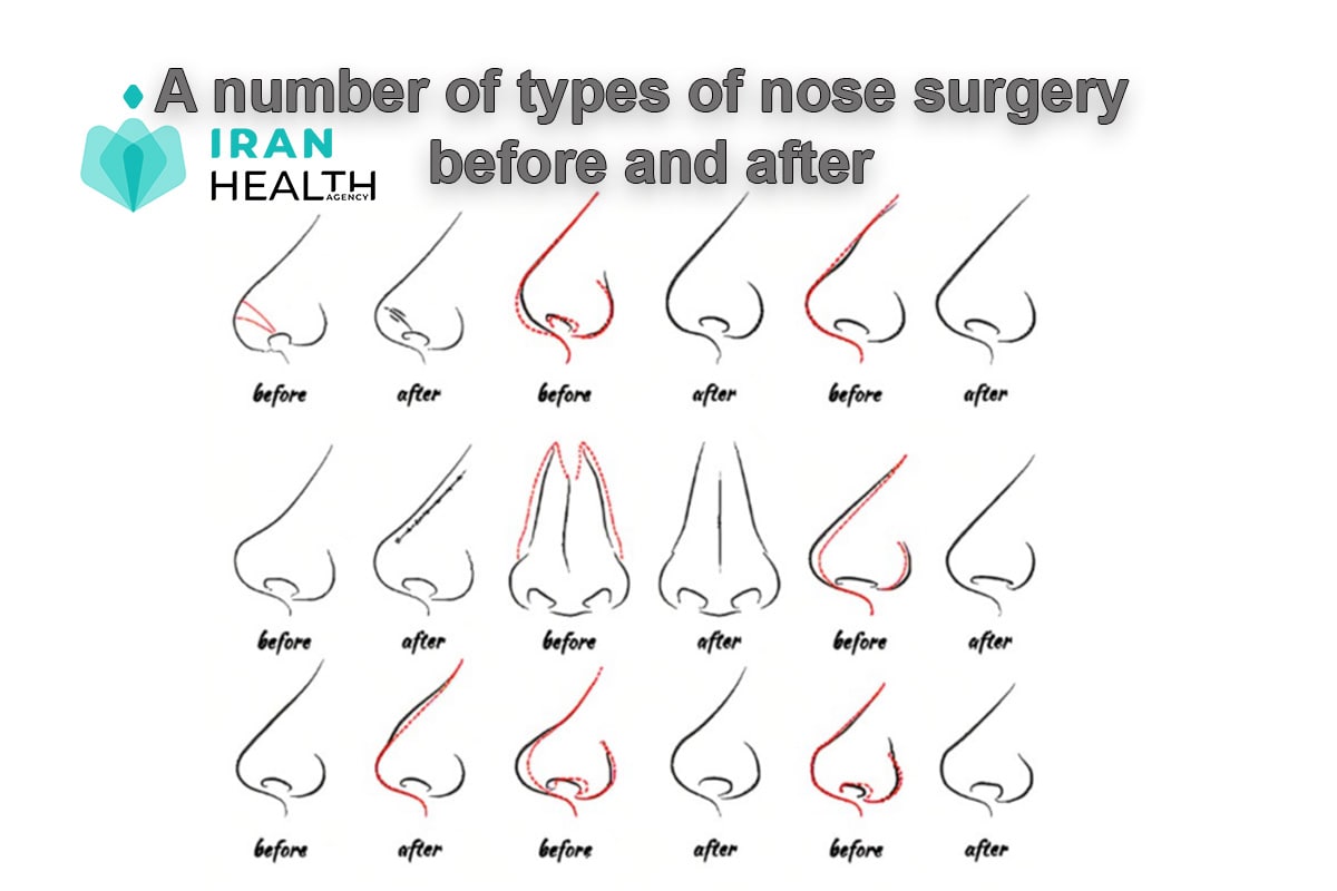 A number of types of nose surgery before and after