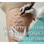 What is the difference between liposuction and Lipomatic?