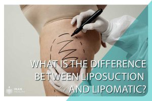What is the difference between liposuction and Lipomatic?