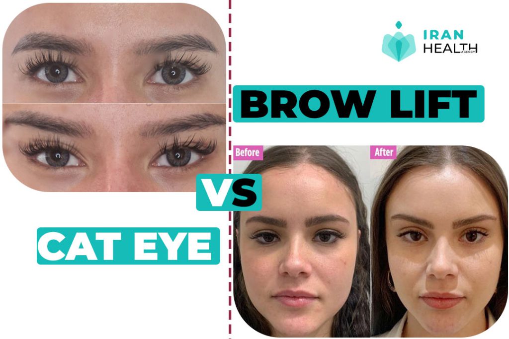 Differentiating cat eye surgery from eyebrow lifts: