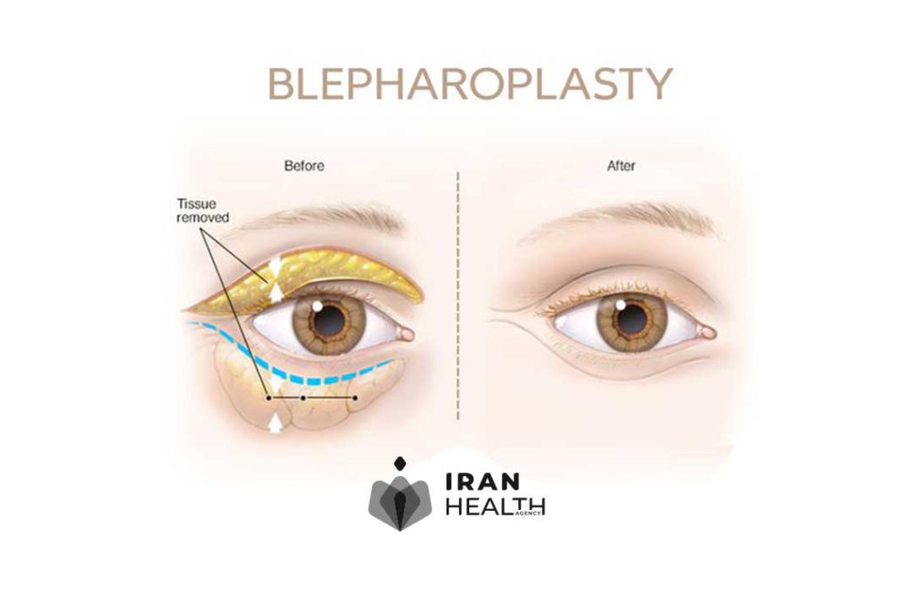 How is Eye Surgery in Iran Performed?