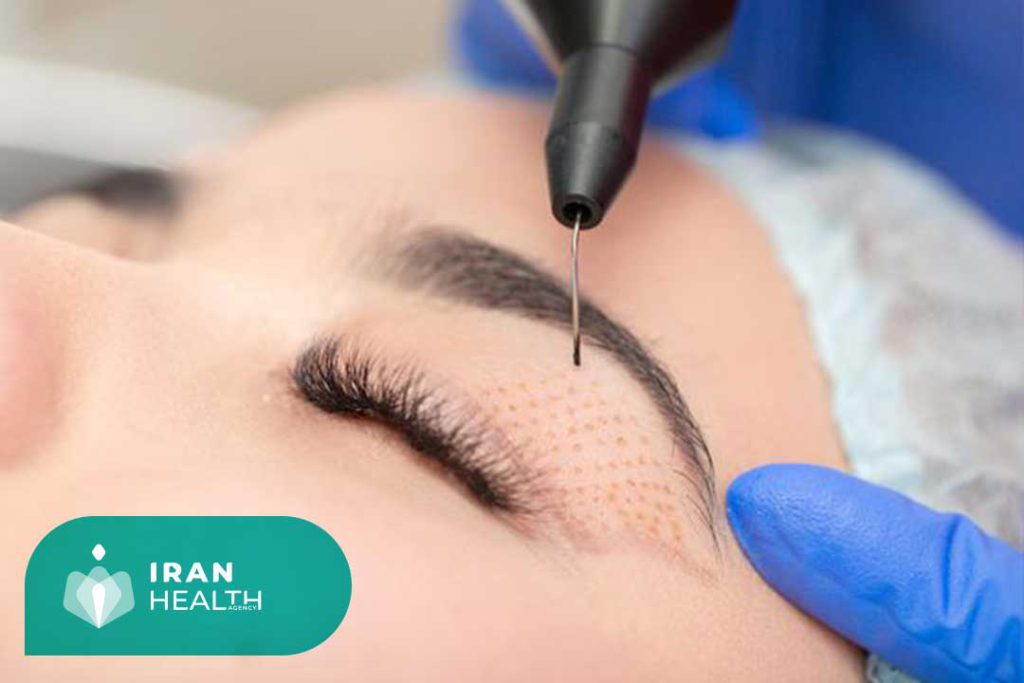 How Much does Eye Surgery in Iran cost?