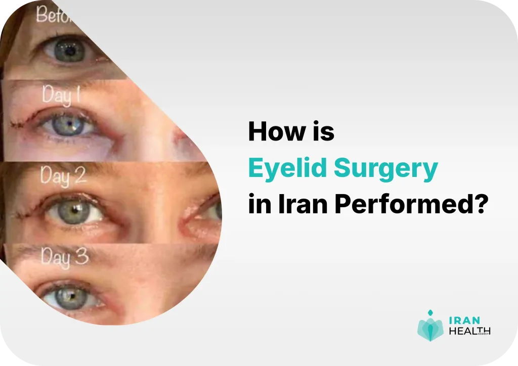 Blepharoplasty in Iran