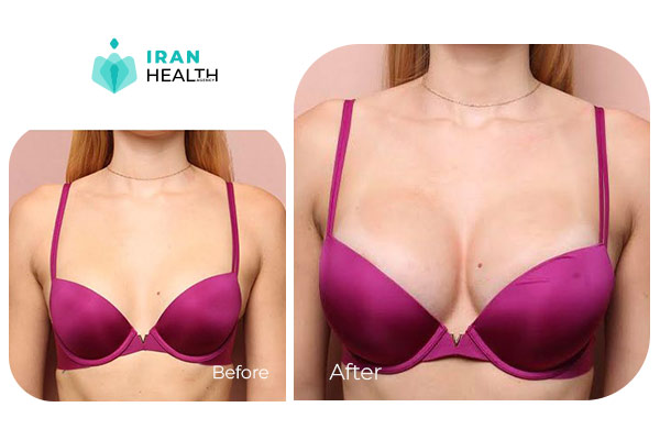 BREAST AUGMENTATION IN IRAN before after photos