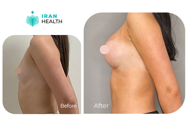 Breast transplant in iran before after photos