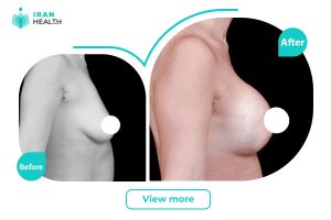 Breast Translat before and after photos (6)