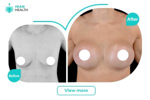 breast transplant before and after photos