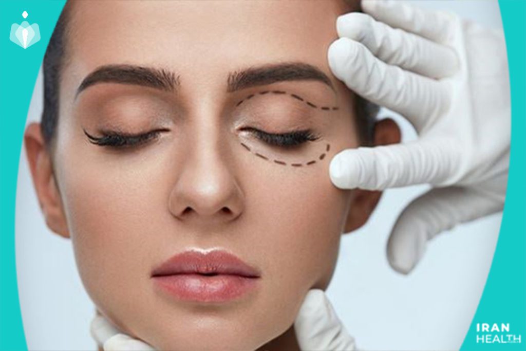 What is a Canthoplasty?