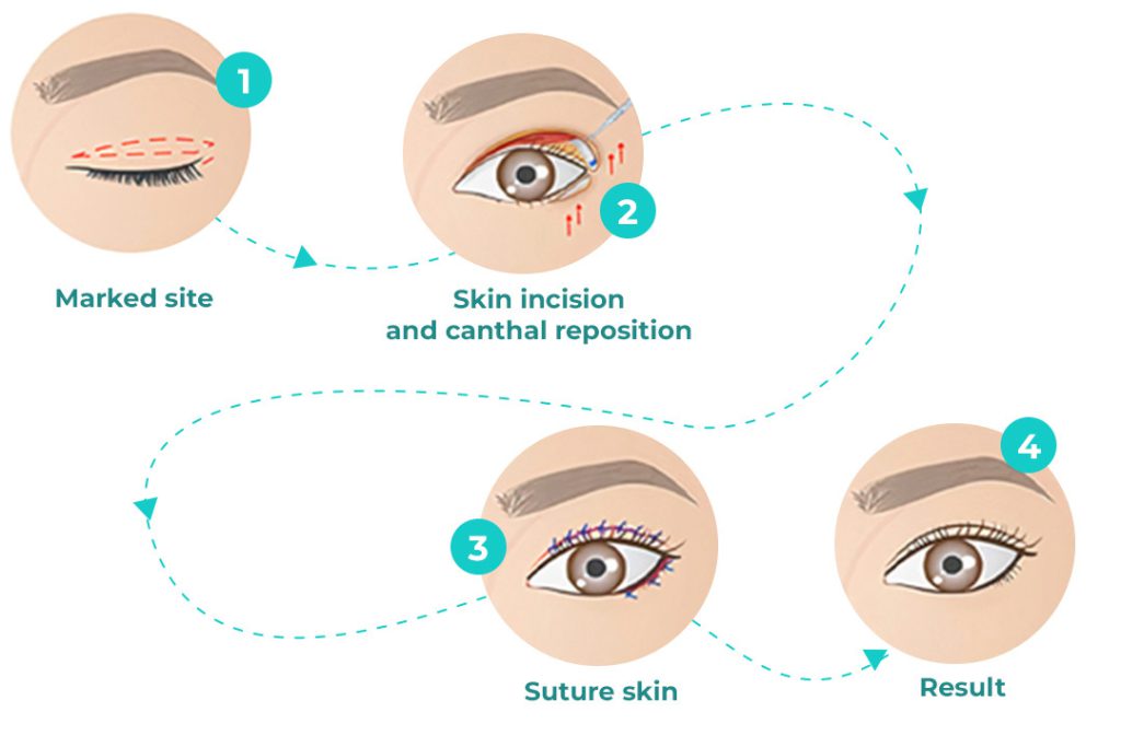 How is Cat Eye Surgery Performed? | Iran Health Agency
